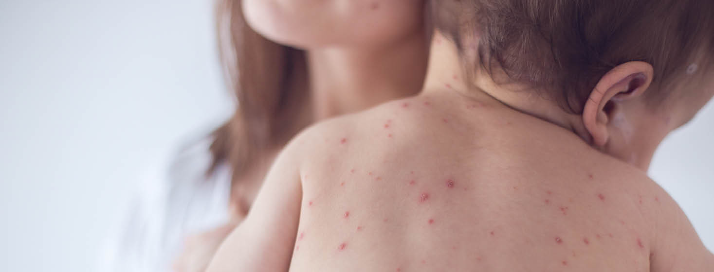 Are Chicken Pox Parties safe