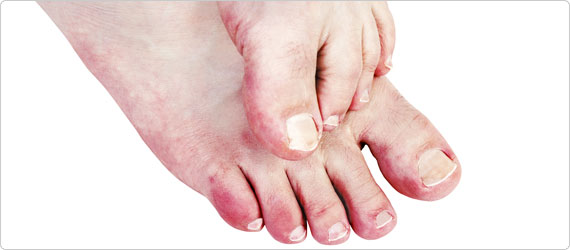 The cold truth about chilblains
