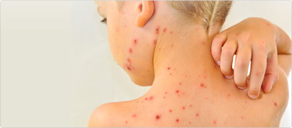 chickenpox-banner Chicken Pox Parties
