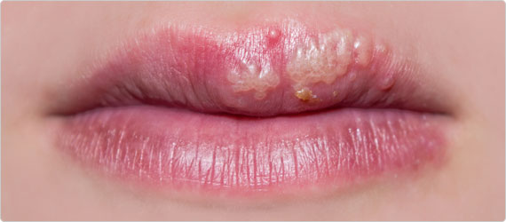 lysine-banner Manage your herpes and cold sore symptoms with Lysine
